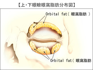 経結膜眼窩脂肪摘出(脱脂)術