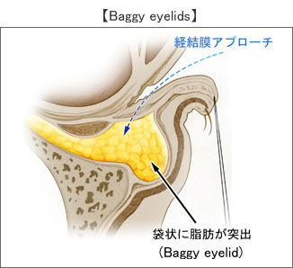 経結膜眼窩脂肪摘出(脱脂)術