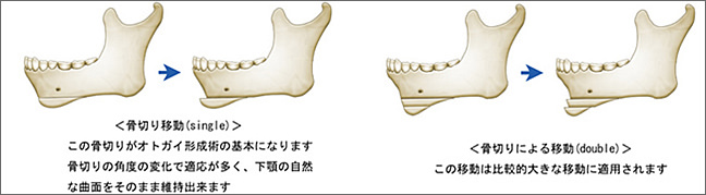 オトガイ水平骨切り術(sliding osteotomy)