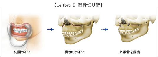 上顎短縮骨切り(LeFortⅠ型)