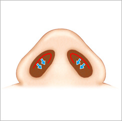 一般のクリニックで行われている鼻尖形成術の問題点