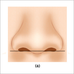 鼻翼-鼻柱関係