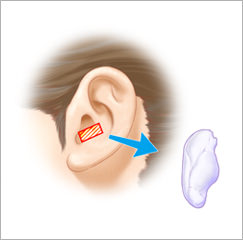 耳介軟骨