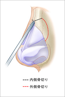 Ⅱ．内側骨切り術(medial osteotomy)